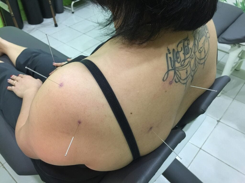 Acupuncture treatment